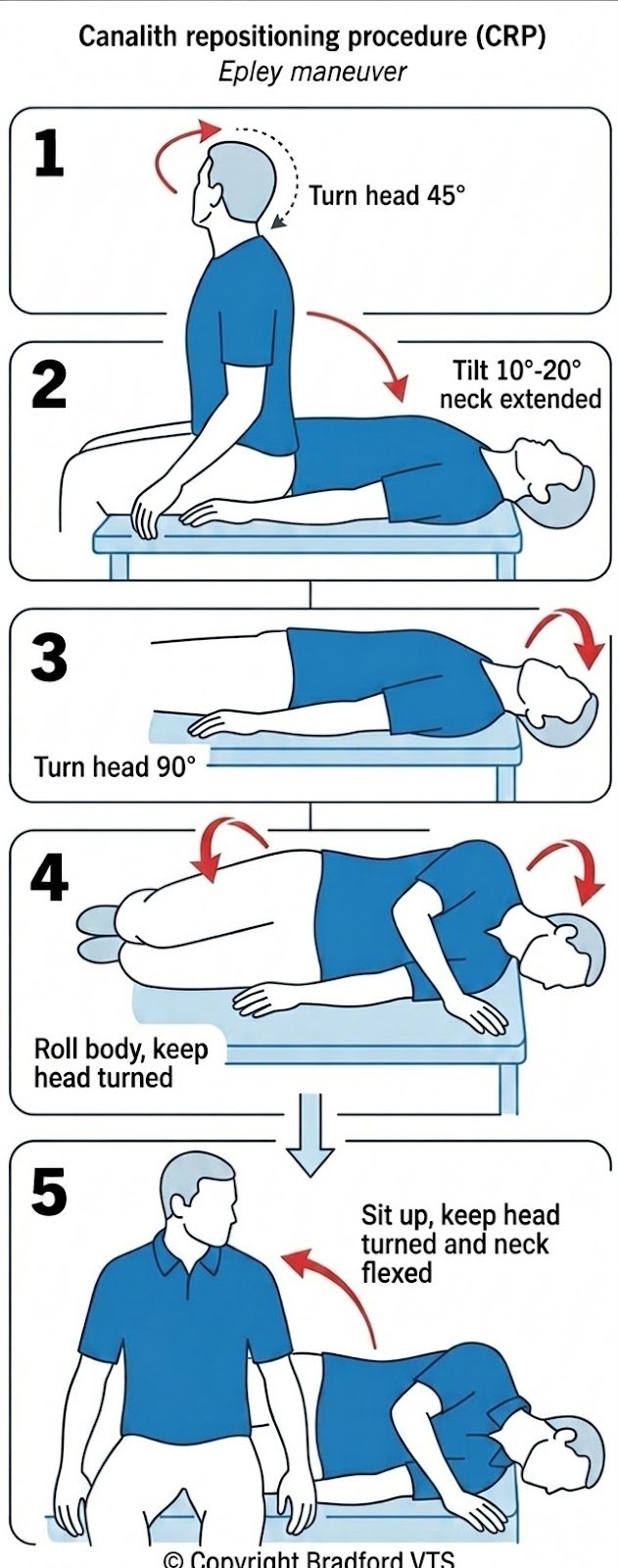 Epley Manoeuvre Step-by-Step Diagram - Canalith Repositioning Procedure